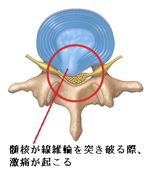 椎間板ヘルニア