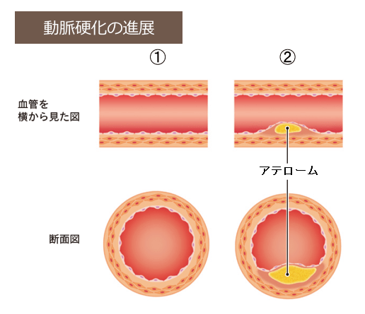 アテロームまで