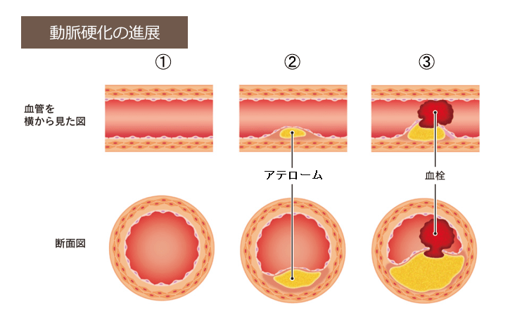 動脈硬化を引き起こすアテローム