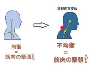 頭部が前方に出る問題