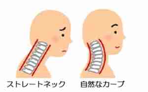 ストレートネック画像 
