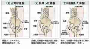 骨盤の歪み画像